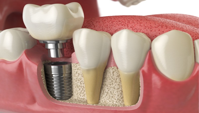 Rediscover Your Smile: Exploring Dental Implants in Surat with West Coast Dental Clinic